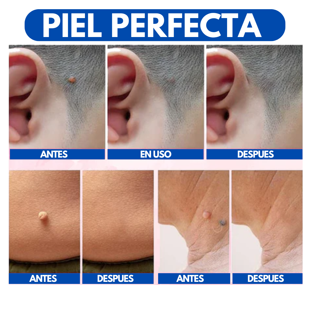 WART REMOVER | REMOVEDOR DE VERRUGAS Y LUNARES